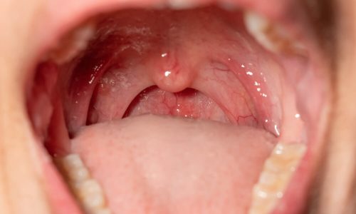 stavrou-orl-tonsillectomy-adenotomy-II